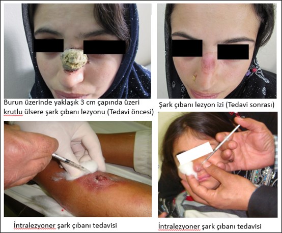 Şanlıurfa’da bu Hastalık için Çalışmalar Başladı 2 Şark Çıbanı