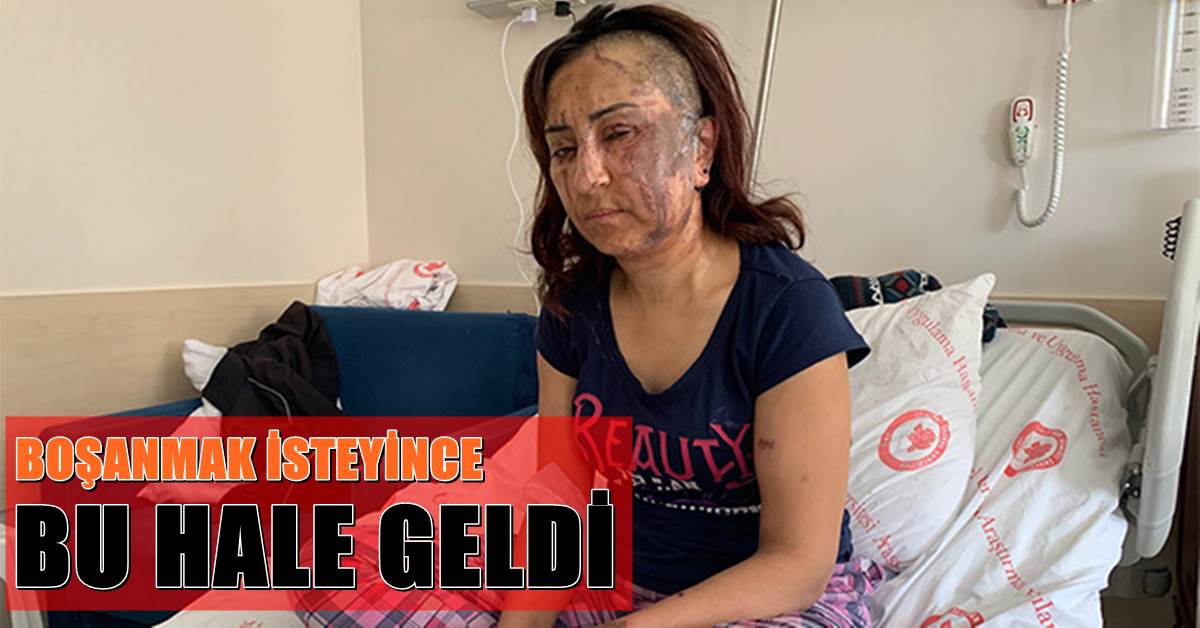 Boşanmak İsteyen Eşine Kezzapla Saldırdı 1 KEZZAP