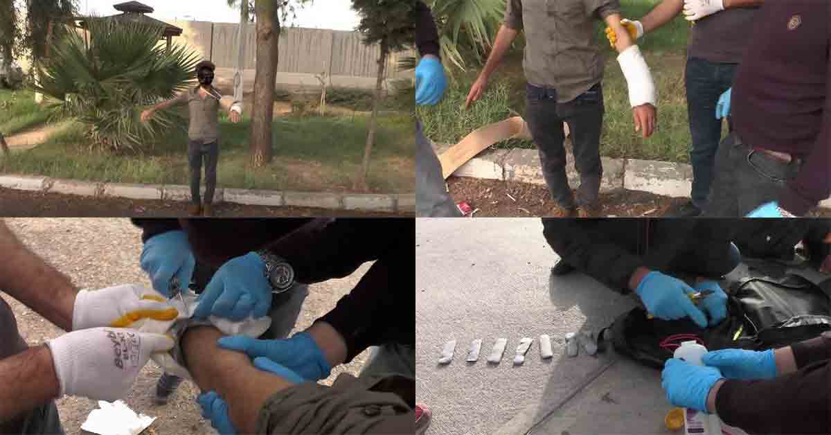 Terörist bombayı kolundaki alçıda kamufle etmiş 1 Koluna sahte alçı ile bomba düzeneği yaptiran Bombacı Suriyeli ele geçirildi