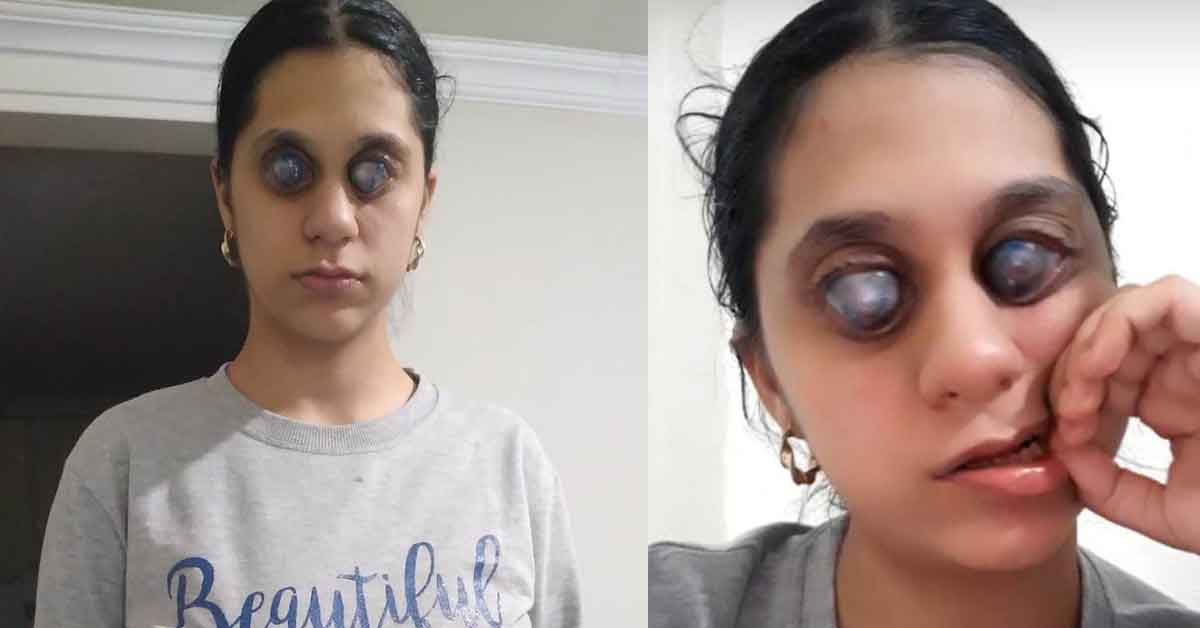 Shop Değil Gerçek! Göz tansiyonu Bu Hale Getirdi 1 Göz Tansiyonu