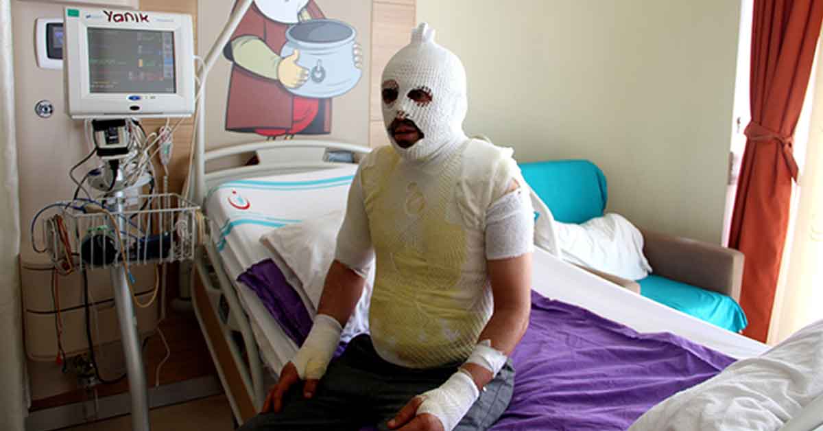 Akrabaları Tarafından Kaynar Suyla Yakıldı 1 Akrabalari Yakti
