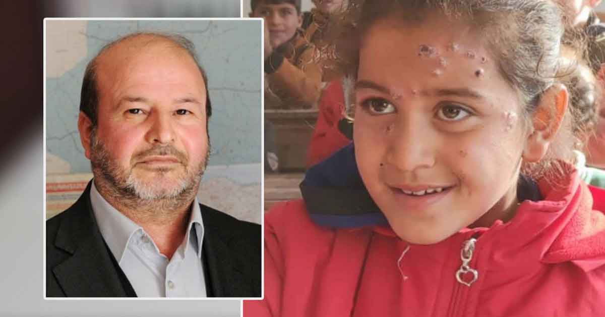 Suriyeliler şark çıbanını Urfa'ya taşıdılar 1 Suriyeliler şark çıbanını Urfa'ya taşıdılar